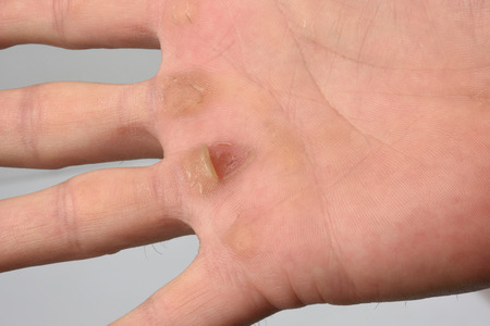 detail of calluses on the palm,