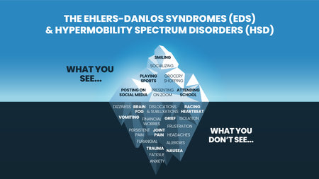 The iceberg model of Ehlers-Danlos Syndromes (EDS) and Hypermobility spectrum disorder (HDS) concept has the surface symptom can see happy and normal behavior for phycological analysis and diagnosticのイラスト素材