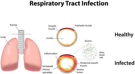 Respiratory Tract Infectionのイラスト素材