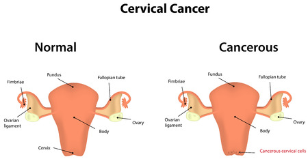 Cervical Cancerのイラスト素材