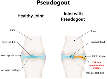 Pseudogoutのイラスト素材