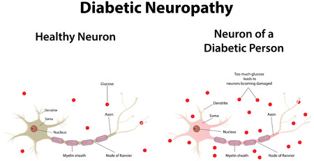 Diabetic Neuropathyのイラスト素材