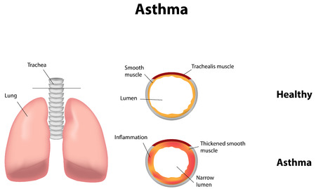Asthmaのイラスト素材