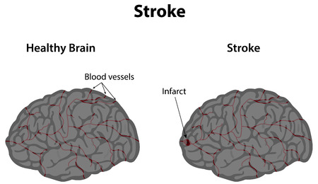 Strokeのイラスト素材