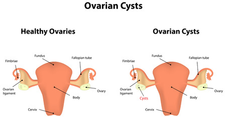 Ovarian Cystsのイラスト素材