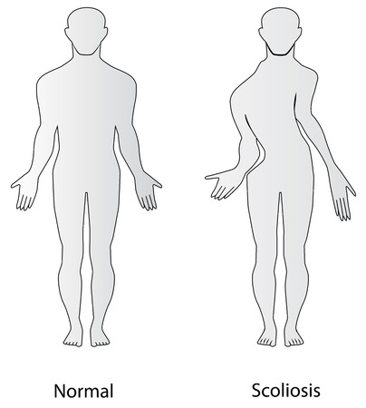 Scoliosisのイラスト素材