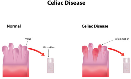 Celiac Diseaseのイラスト素材