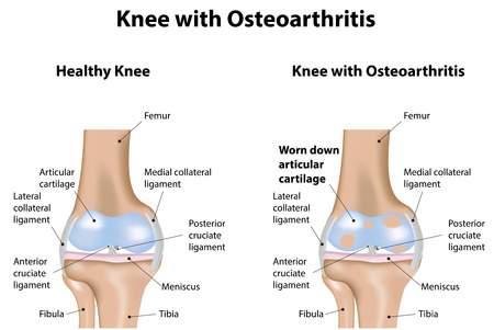 Knee with Osteoarthritisのイラスト素材