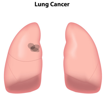 Lung Cancerのイラスト素材