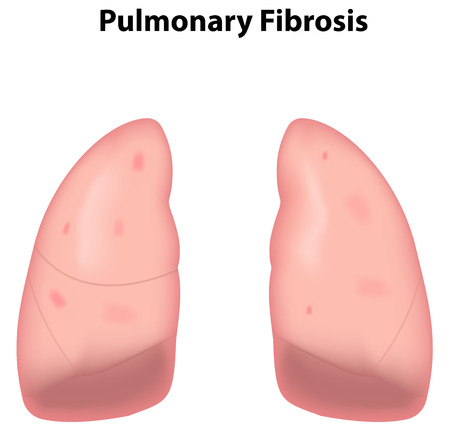Pulmonary Fibrosisのイラスト素材