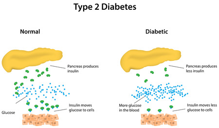 Type 2 Diabetes Labeled Diagramのイラスト素材