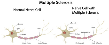 Multiple Sclerosis