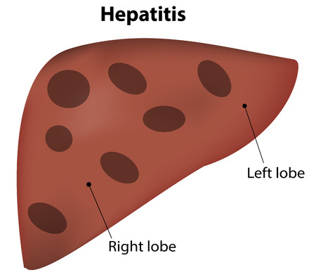 Hepatitisのイラスト素材