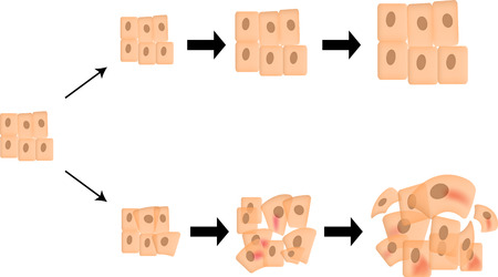 Cancer Progressionのイラスト素材