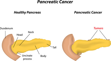 Pancreatic Cancerのイラスト素材