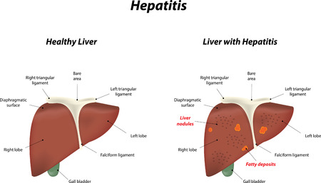 Hepatitisのイラスト素材