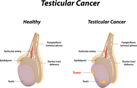 Testicular Cancerのイラスト素材