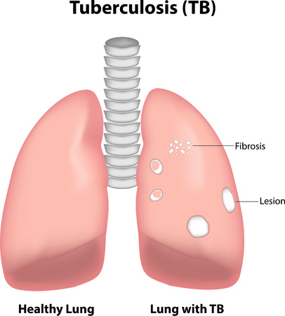 Tuberculosis (TB)のイラスト素材