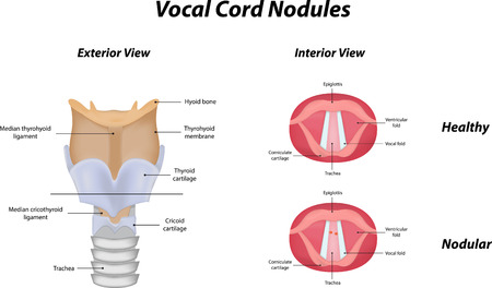 Vocal Cord Nodules Illustrationのイラスト素材