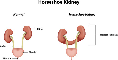 Horseshoe Kidney labeled Diagramのイラスト素材