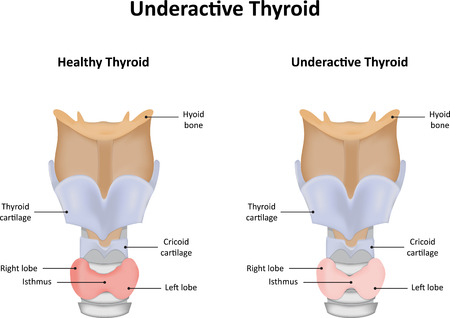 Underactive Thyroid Glandのイラスト素材
