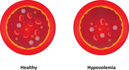 Hypovolaemiaの写真素材