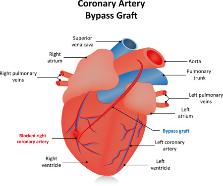 Coronary Artery Bypass Graft CABGの写真素材