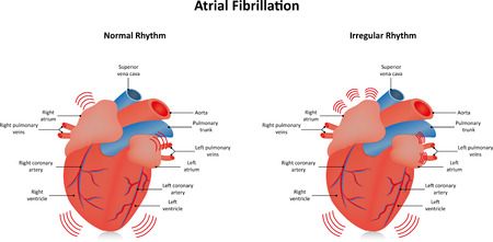 Atrial Fibrillationのイラスト素材