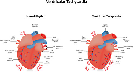 Ventricular Tachycardia V-tachのイラスト素材