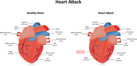 Heart Attack Myocardial Infarctionのイラスト素材