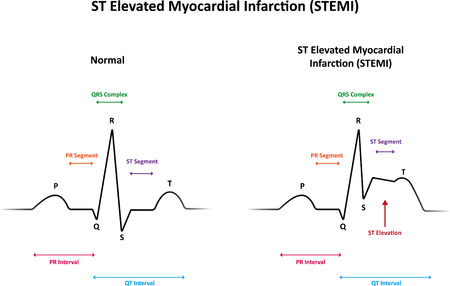 ST Elevated Myocardial Infarction STEMI