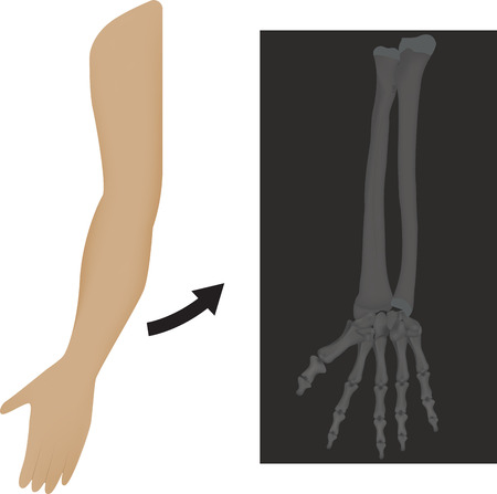 Radiograph X Ray of Wristのイラスト素材