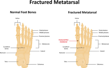Fractured Metatarsalのイラスト素材