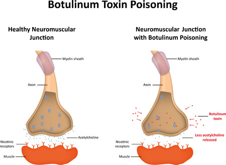 Botulinum Toxin Poisoningのイラスト素材