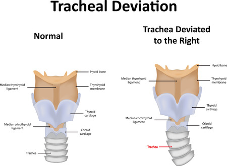 Tracheal Deviation Illustrationのイラスト素材