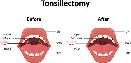 Tonsillectomyのイラスト素材