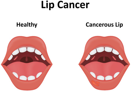 Lip cancerの写真素材