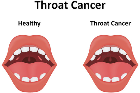 Throat Cancerのイラスト素材