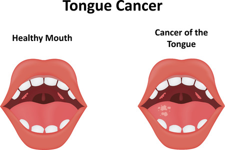 Tongue Cancerのイラスト素材