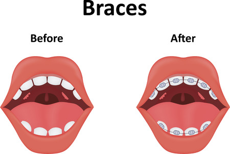 Bracesの写真素材