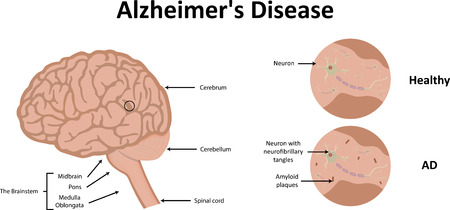 Alzheimer's Diseaseのイラスト素材