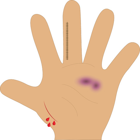 Hand Injuryのイラスト素材