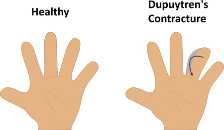Dupuytren's Contractureのイラスト素材