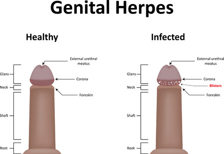 Genital Herpesのイラスト素材