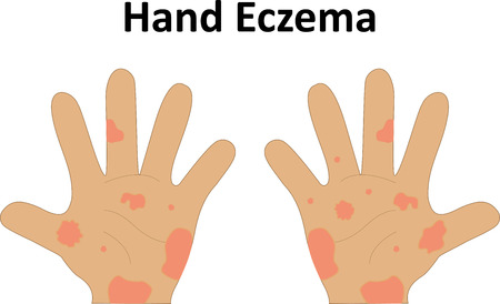 Eczema on the Handの写真素材