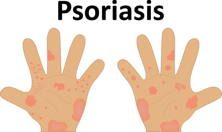 Psoriasisの写真素材