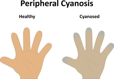 Peripheral Cyanosisの写真素材