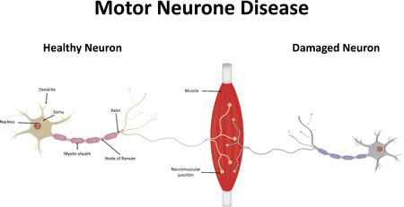Motor Neurone Diseaseのイラスト素材