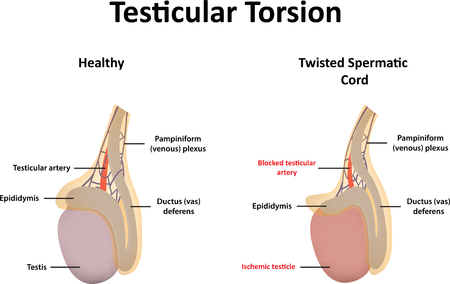 Testicular Torsionのイラスト素材