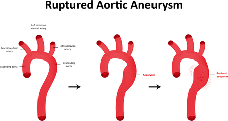 Ruptured Aortic Aneurysmの写真素材